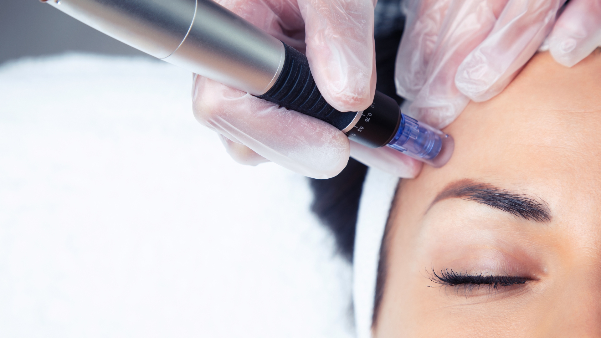 Microneedling